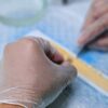 Detailed view of hair graft preparation during a hair transplant surgery.