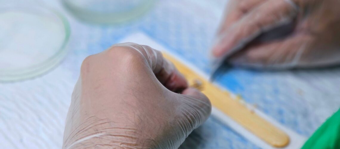 Detailed view of hair graft preparation during a hair transplant surgery.