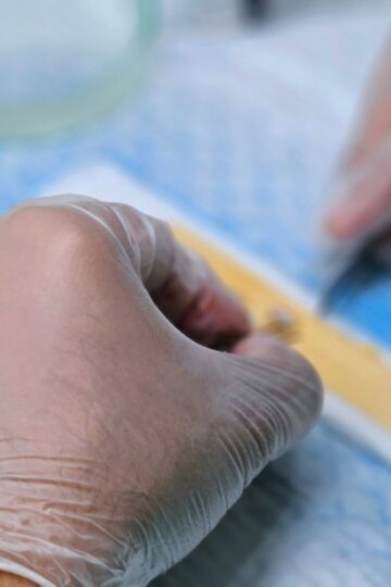 Detailed view of hair graft preparation during a hair transplant surgery.