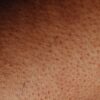 Detailed close-up view of human skin surface showing natural texture and imperfections.