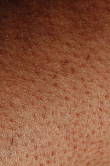 Detailed close-up view of human skin surface showing natural texture and imperfections.