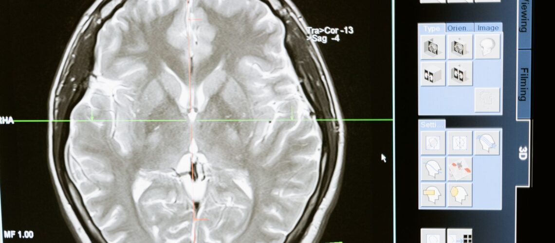 Intricate MRI brain scan displayed on a computer screen for medical analysis and diagnosis.