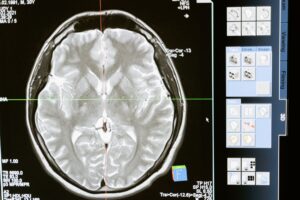 La sclérose en plaques : comprendre, diagnostiquer et vivre avec la maladie
