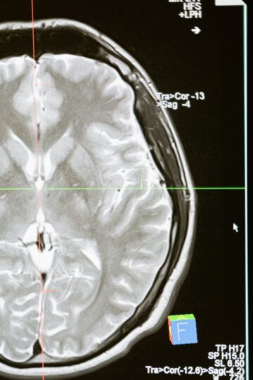 Intricate MRI brain scan displayed on a computer screen for medical analysis and diagnosis.