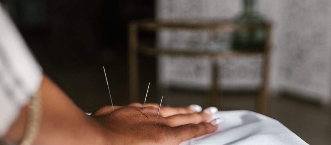 Close-up of acupuncture needles in a hand during treatment, promoting relaxation.