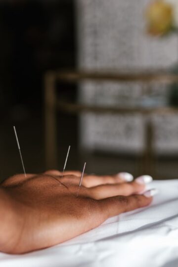 Close-up of acupuncture needles in a hand during treatment, promoting relaxation.