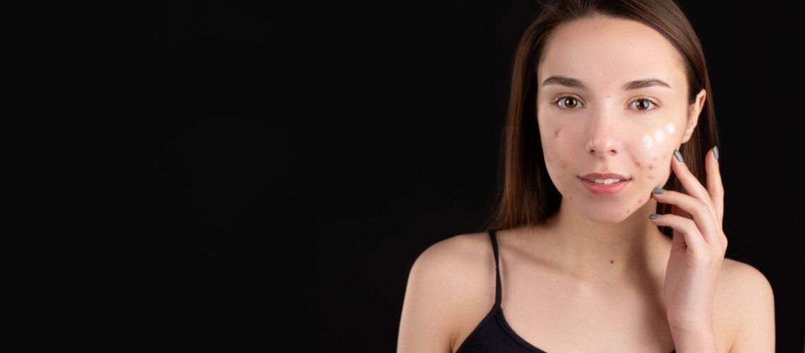 Teenage girl with acne applying skincare cream on face, isolated black background.