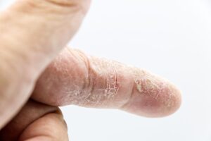 L'eczéma : comprendre, reconnaître et traiter cette maladie de peau