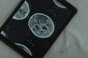 L'épilepsie : comprendre cette maladie neurologique
