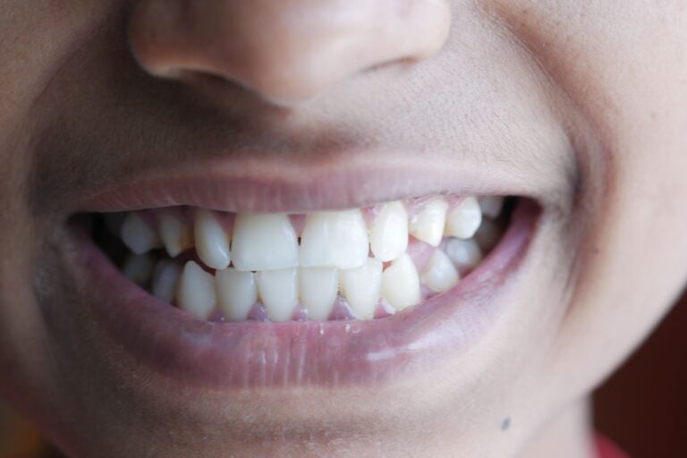 Les dents incisives : anatomie, rôles et soins essentiels
