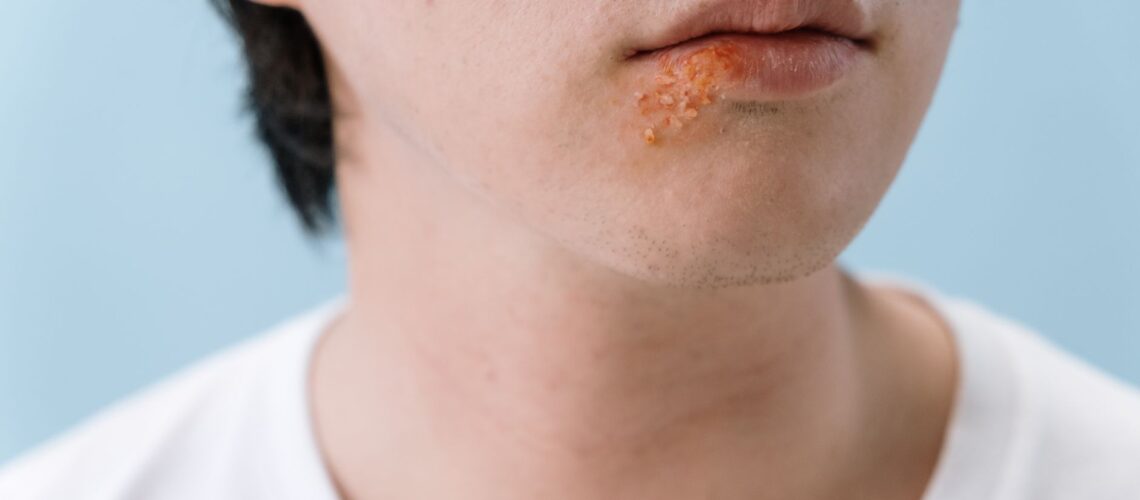 A close-up image of a person's lips showing a cold sore on the lower lip area.