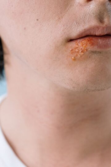 A close-up image of a person's lips showing a cold sore on the lower lip area.