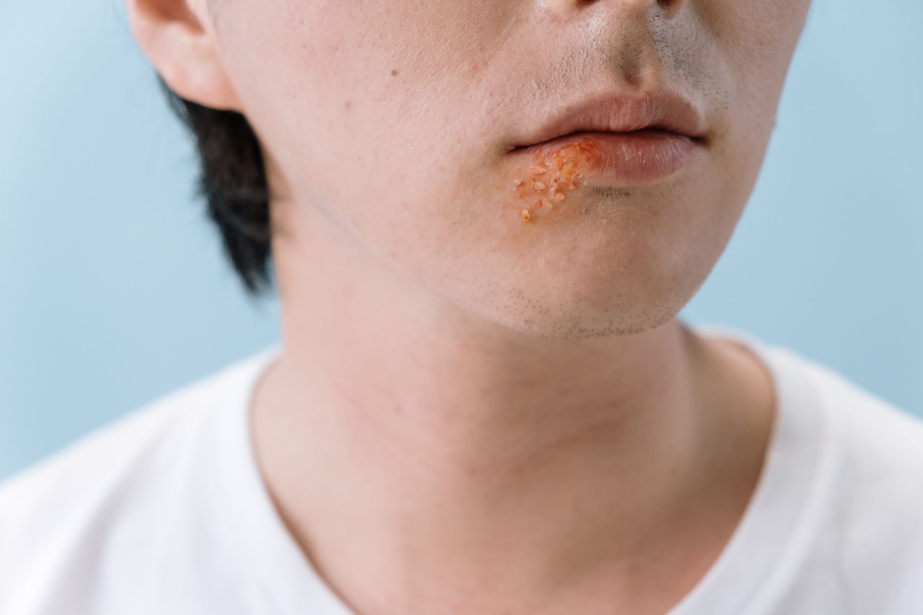 L’herpès simplex : comprendre le virus, ses formes et ses traitements