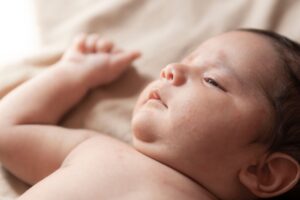 Acné du nouveau-né : causes, symptômes et traitements efficaces