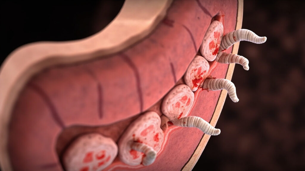 Ancylostoma duodenale : comprendre l’ankylostomiase et ses conséquences sur la santé : zone du corps concernée