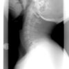 Articulation atlanto-occipitale : anatomie, biomécanique et pathologies