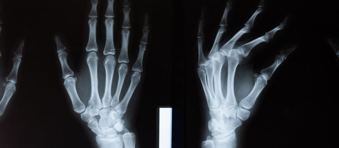 High-resolution x-ray image showing the intricate anatomy of human hands.