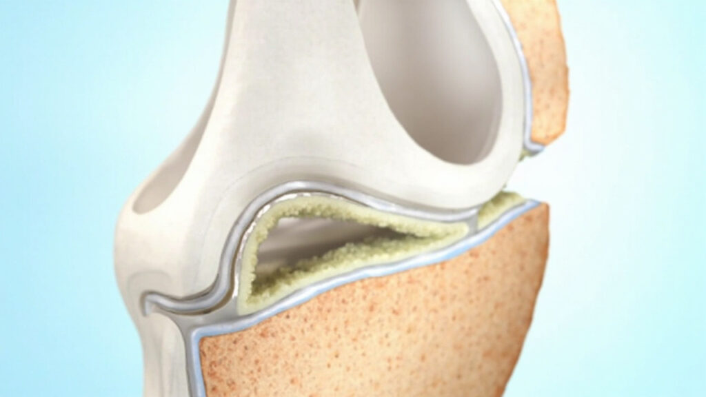 Articulation synoviale : anatomie, fonctionnement et pathologies : zone du corps concernée