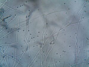 Blastomycose : causes, symptômes, diagnostic et traitement de cette infection fongique
