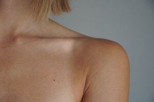 Brûlure du premier degré : causes, symptômes, traitement et prévention