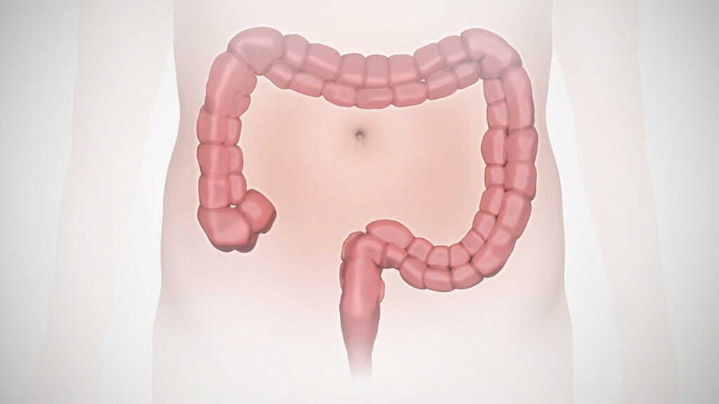 Cancer du rectum : symptômes, diagnostic et traitements actuels : prise en charge
