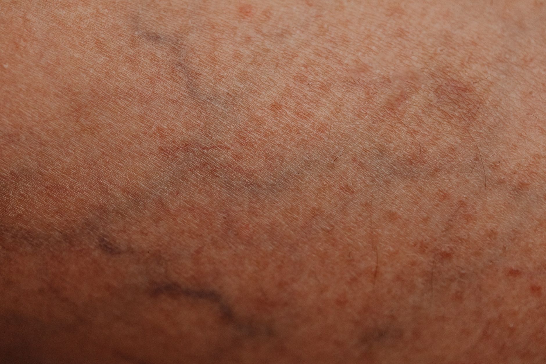 Candidose cutanée : causes, symptômes, diagnostic et traitements