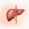 Carcinome hépatocellulaire : causes, symptômes, diagnostic et traitements