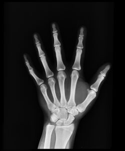 Cartilage épiphysaire : structure, fonction et pathologies de la plaque de croissance