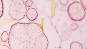 Cellules de Langerhans : rôle essentiel dans l'immunité cutanée