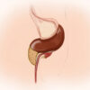 Cholecystite chronique : causes, symptômes, diagnostic et traitement