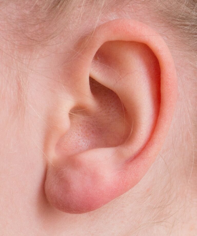 Chondrite auriculaire : causes, symptômes et traitements