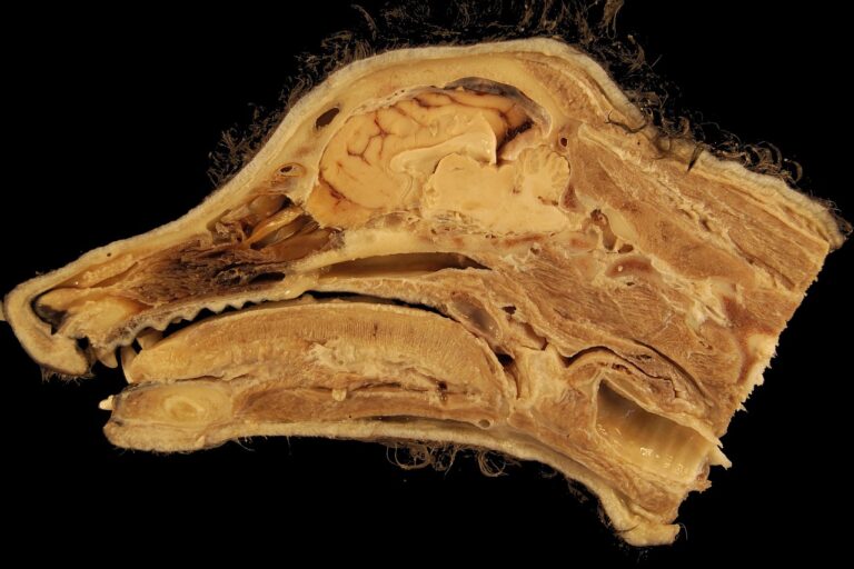 Cloison nasale : anatomie, fonctions et pathologies