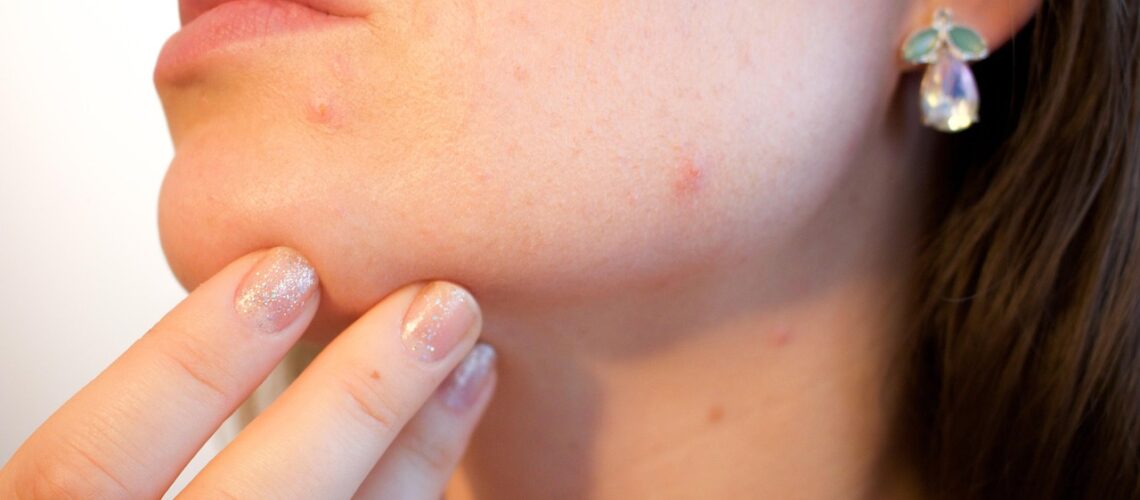 Dermatite séborrhéique : causes, symptômes et traitements efficaces