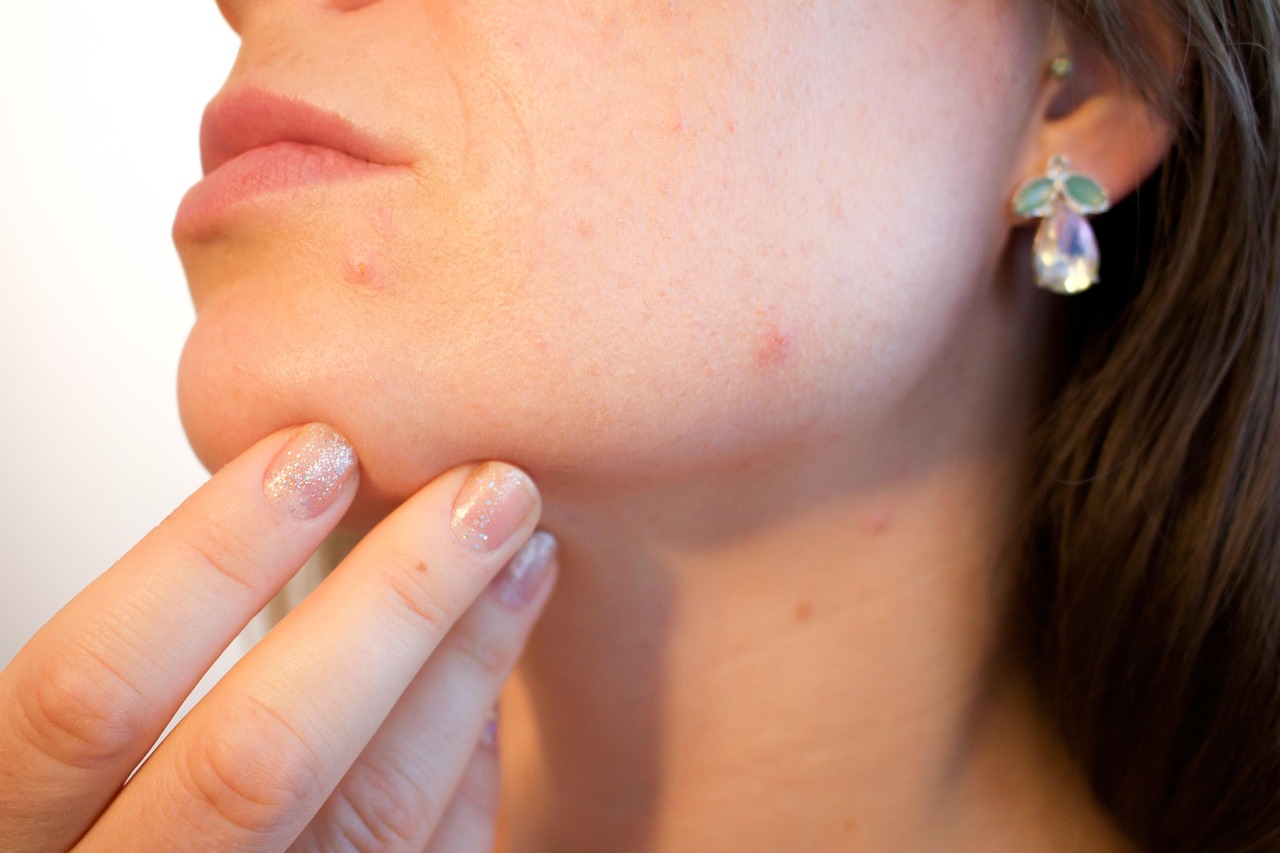 Dermatite séborrhéique : causes, symptômes et traitements efficaces