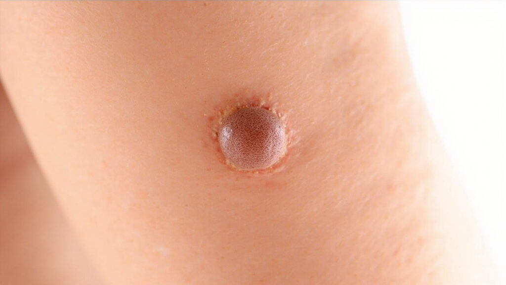 Dermatofibrome : causes, symptômes, diagnostic et traitement : vue générale