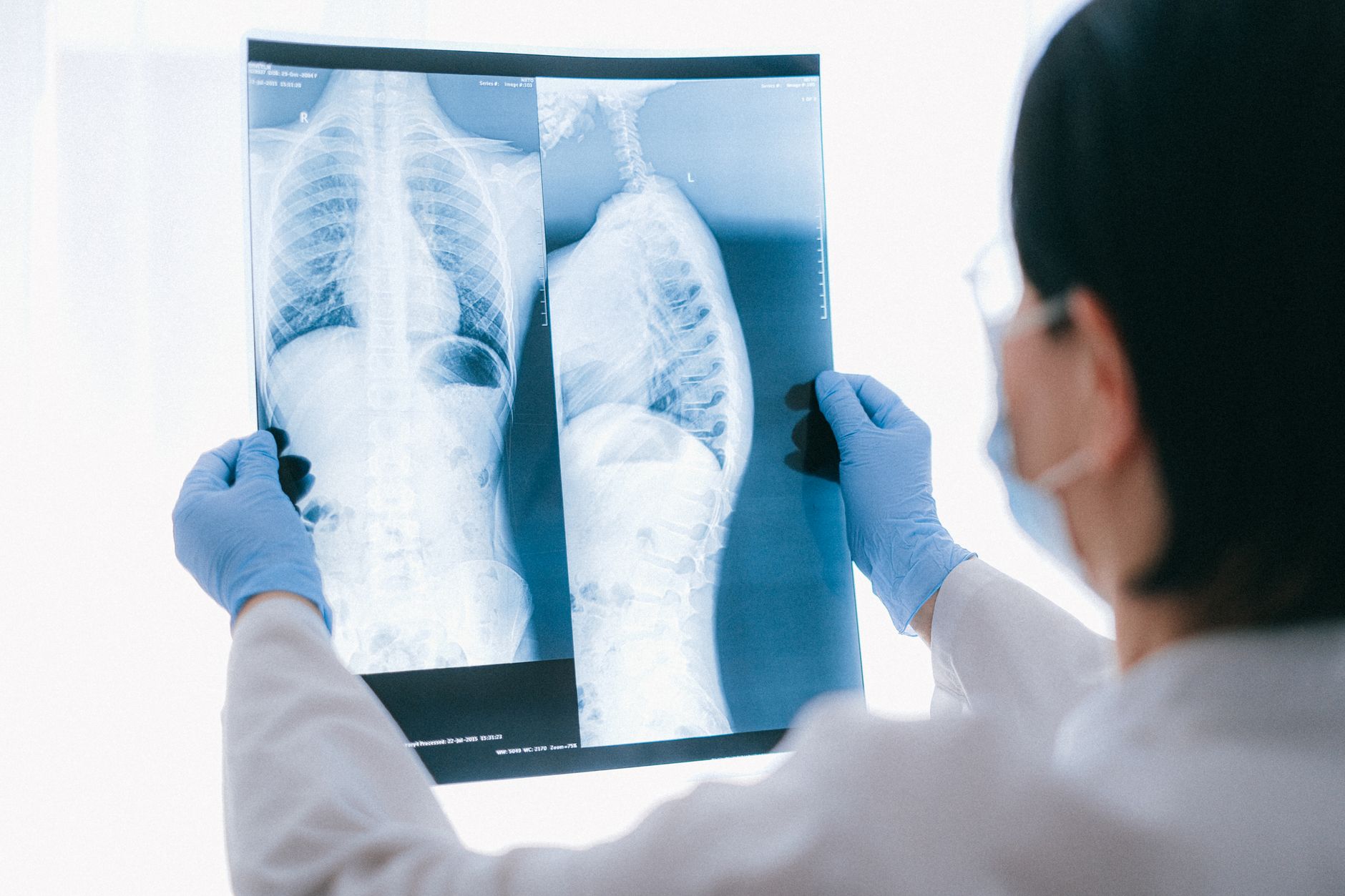 Emphysème lobaire : causes, symptômes, diagnostic et traitement