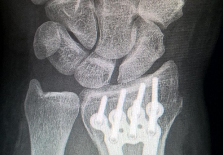 Fracture de Pouteau-Colles : causes, symptômes et traitement
