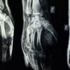 Close-up X-ray showing detailed view of human hand bones.