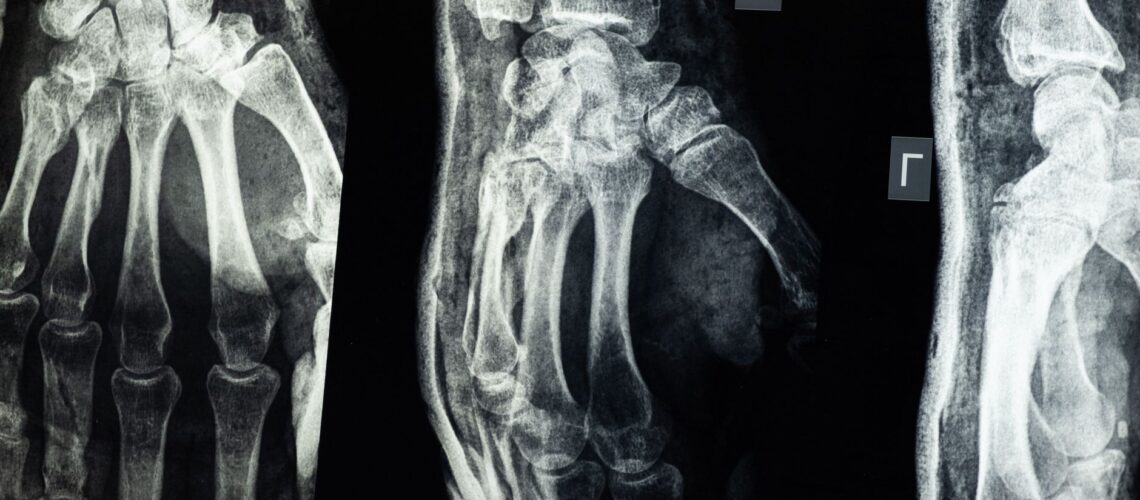 Close-up X-ray showing detailed view of human hand bones.