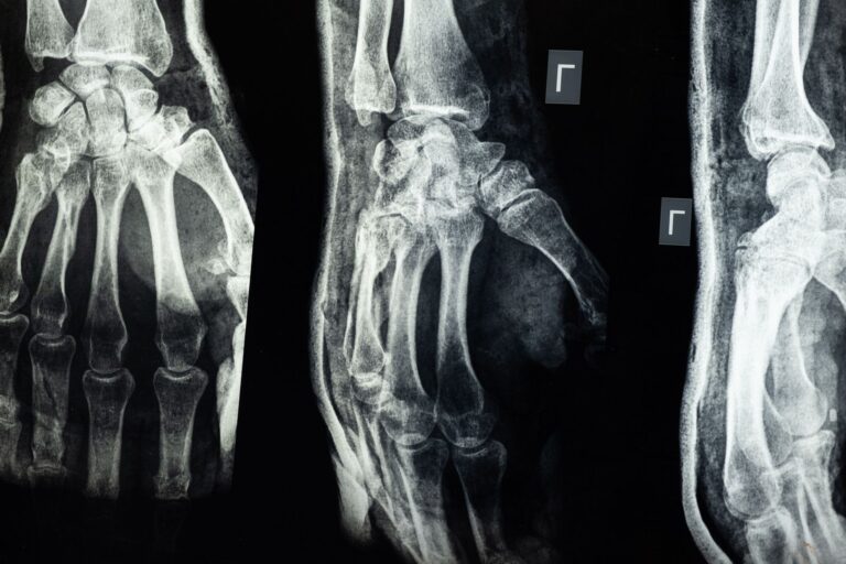 Fractures osseuses : comprendre, diagnostiquer et traiter