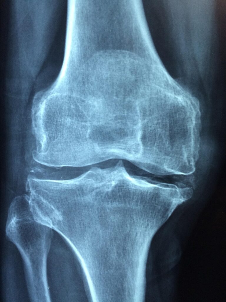 Gonarthrose : comprendre, diagnostiquer et traiter l&rsquo;arthrose du genou