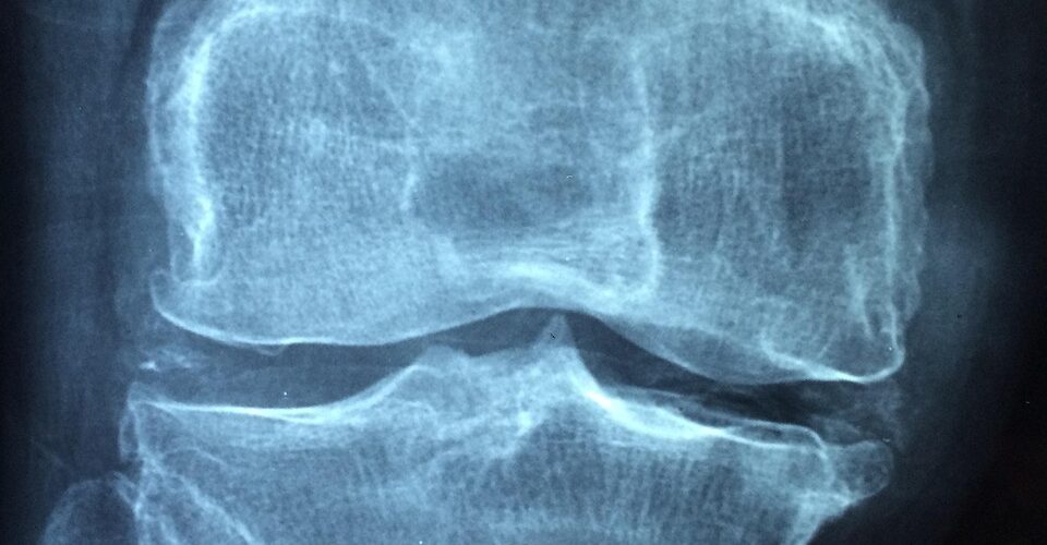Gonarthrose : comprendre, diagnostiquer et traiter l'arthrose du genou