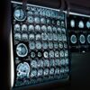 Hématome sous-dural : causes, symptômes, diagnostic et traitement