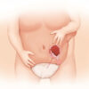 Hernie diaphragmatique congénitale : causes, diagnostic et prise en charge