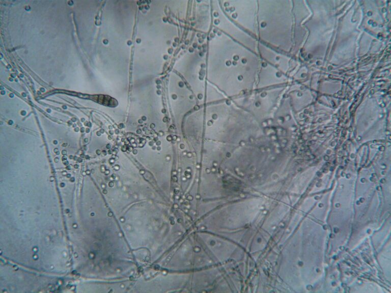 Histoplasmose : causes, symptômes, diagnostic et traitement de cette infection fongique