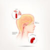 Hyperphosphatémie : causes, symptômes, diagnostic et traitements