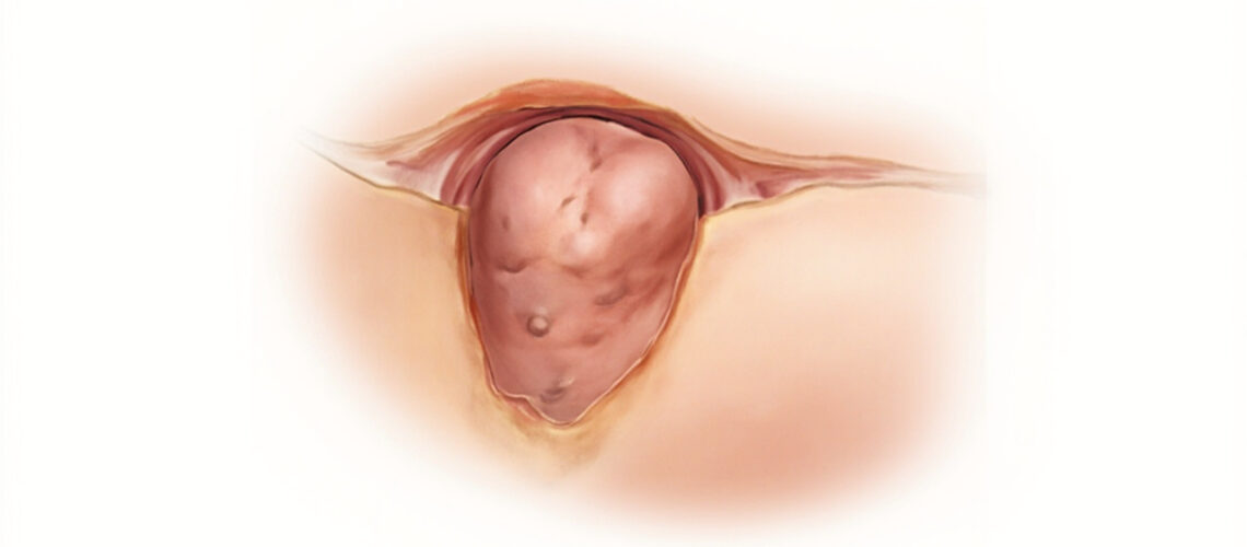 Kyste dermoïde : causes, symptômes, diagnostic et traitement
