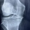 L'articulation du genou : anatomie complète, fonctionnement et pathologies