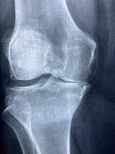 L'articulation du genou : anatomie complète, fonctionnement et pathologies