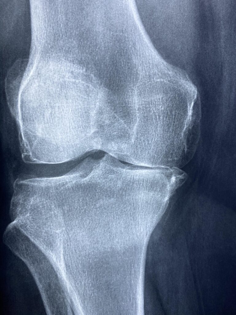 L&rsquo;articulation du genou : anatomie complète, fonctionnement et pathologies